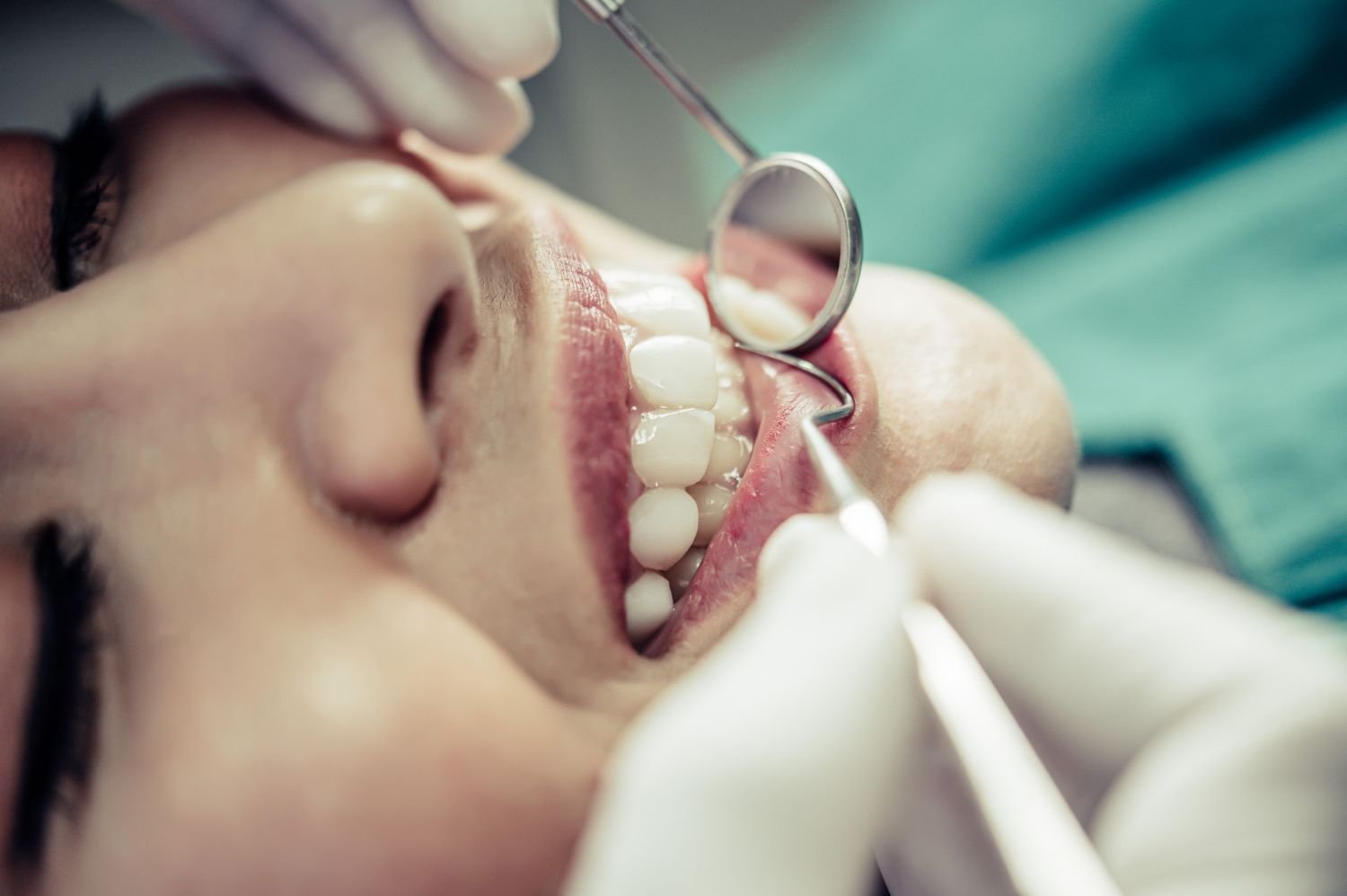 Esthetic Fillings and Broken Teeth Repair
